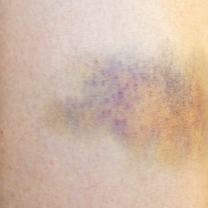 bruising